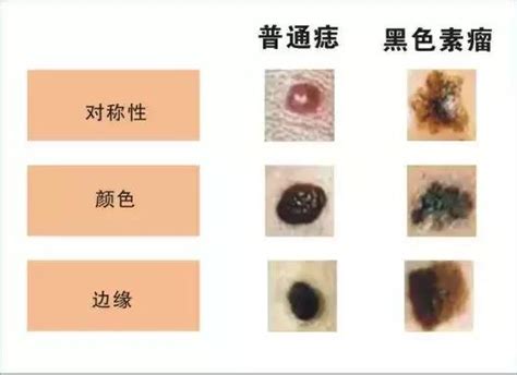 陰莖痣|陰莖上的痣：該看皮膚科還是泌尿科？手術後恢復期大約多久？